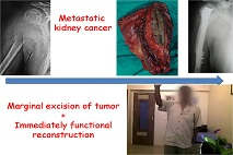 bone cancer doctor in Jamnagar